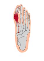 Hallux valgus mjukt bandage 